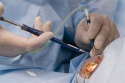 Eye Institute Cataract Surgery