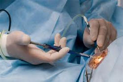 Optical Express Cataract Surgery